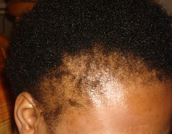 Hair Loss