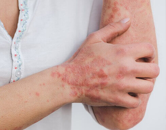 Psoriasis