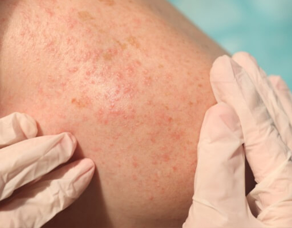Dermatology Disorders