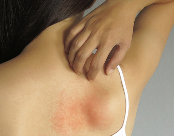 Skin Infections